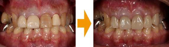 前歯5本をジルコニアオールセラミッククラウンにて修復の治療前と治療後の写真