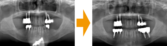 下顎に3本のインプラントを埋入の治療前と治療後の写真